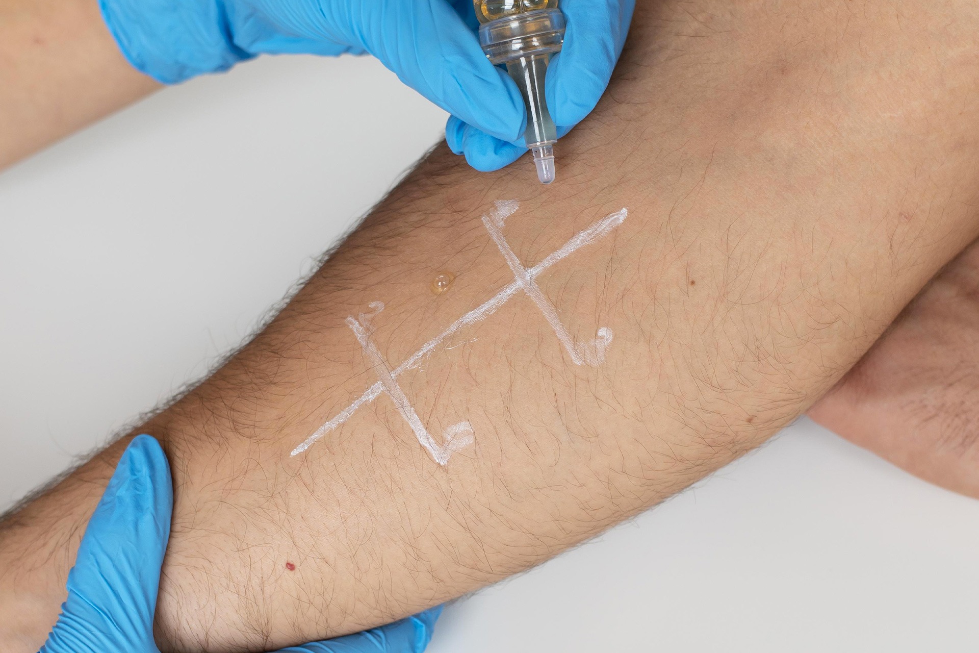 Allergie a Brescia: sintomi da non sottovalutare, pollini e quando fare una visita allergologica